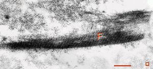 F,44y. | striations of fibrin - heart atrium, myxoma F,44y. | striations of fibrin - heart atrium, myxoma